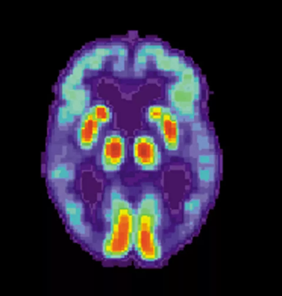 PET obraz mozku pacienta s Alzheimerovou chorobou (Foto: Wikipedia.org)